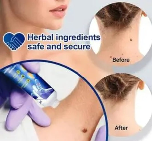 Wart remover painless solution