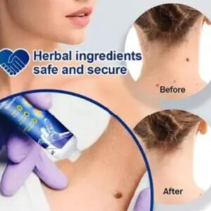 Wart remover painless solution